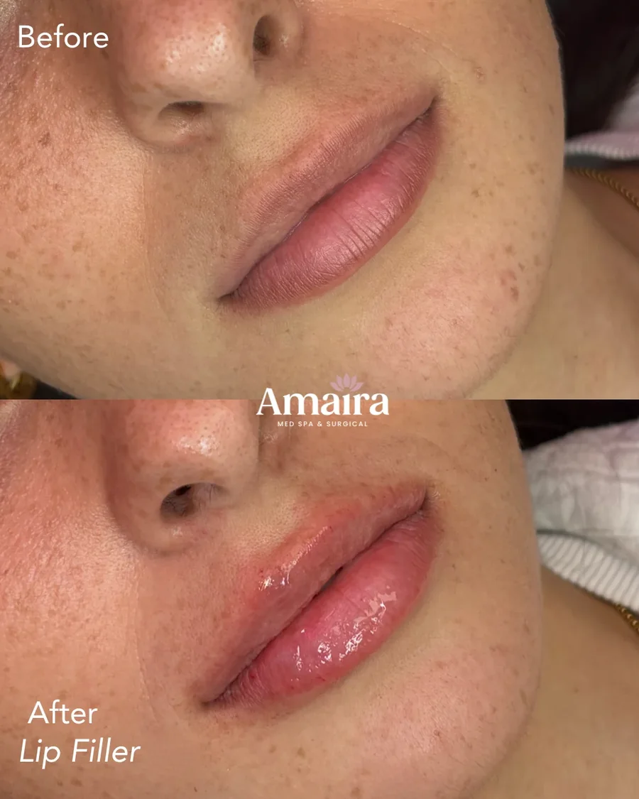 Lip filler before and after, lip shape and volume, three-quarter close-up, patient 7