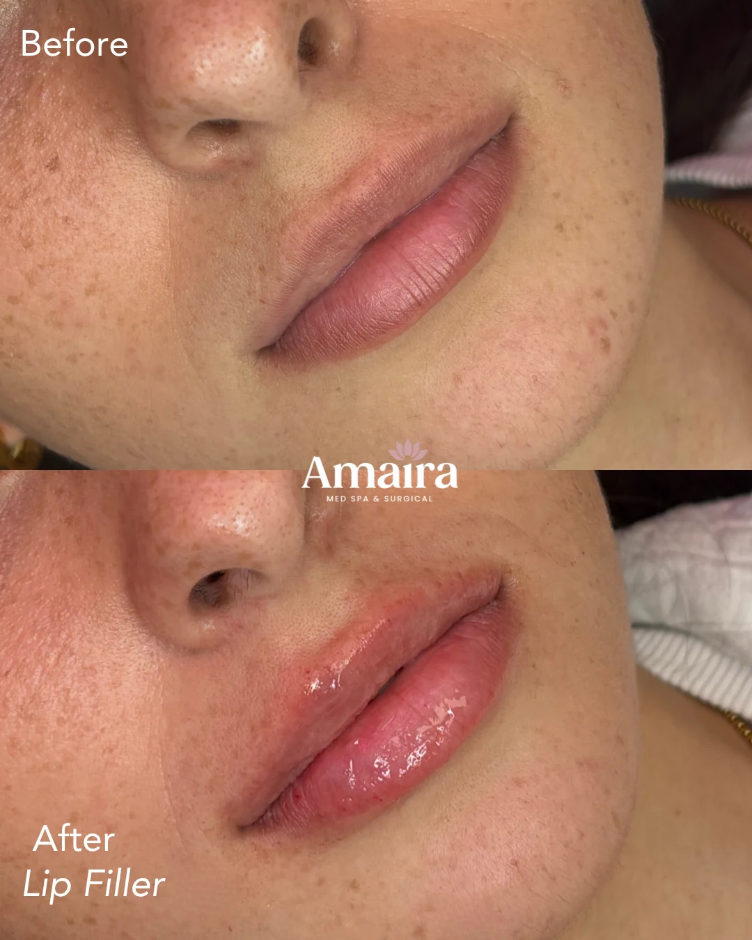 Lip filler before and after, lip shape and volume, three-quarter close-up, patient 7, enlarged
