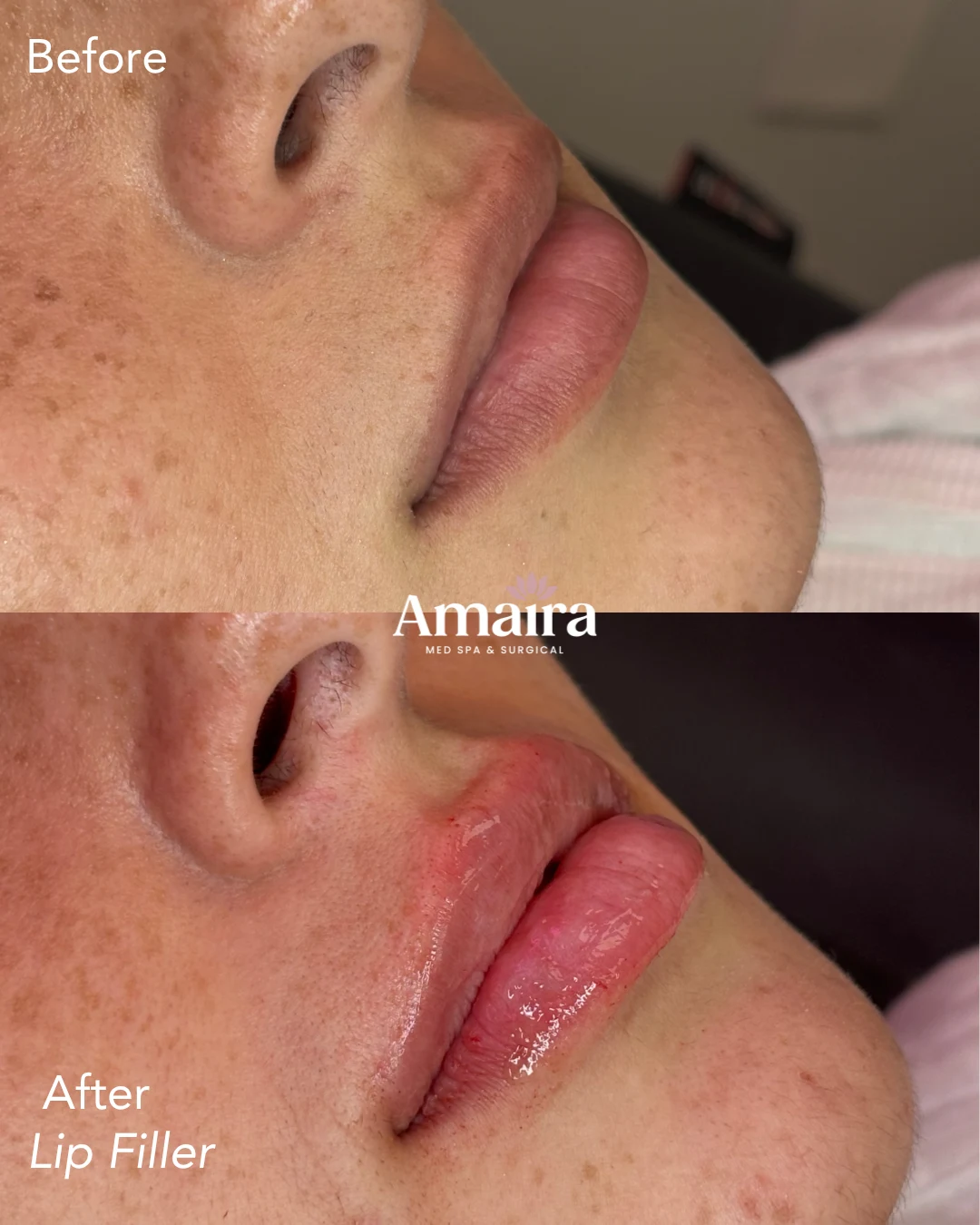 Lip filler before and after, lip projection, side close-up, patient 7, enlarged