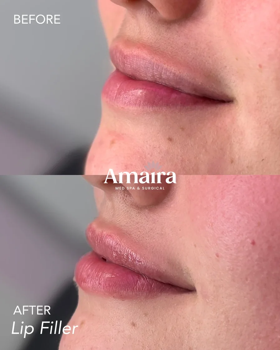 Lip filler before and after, upper lip projection, side profile close-up, patient 8