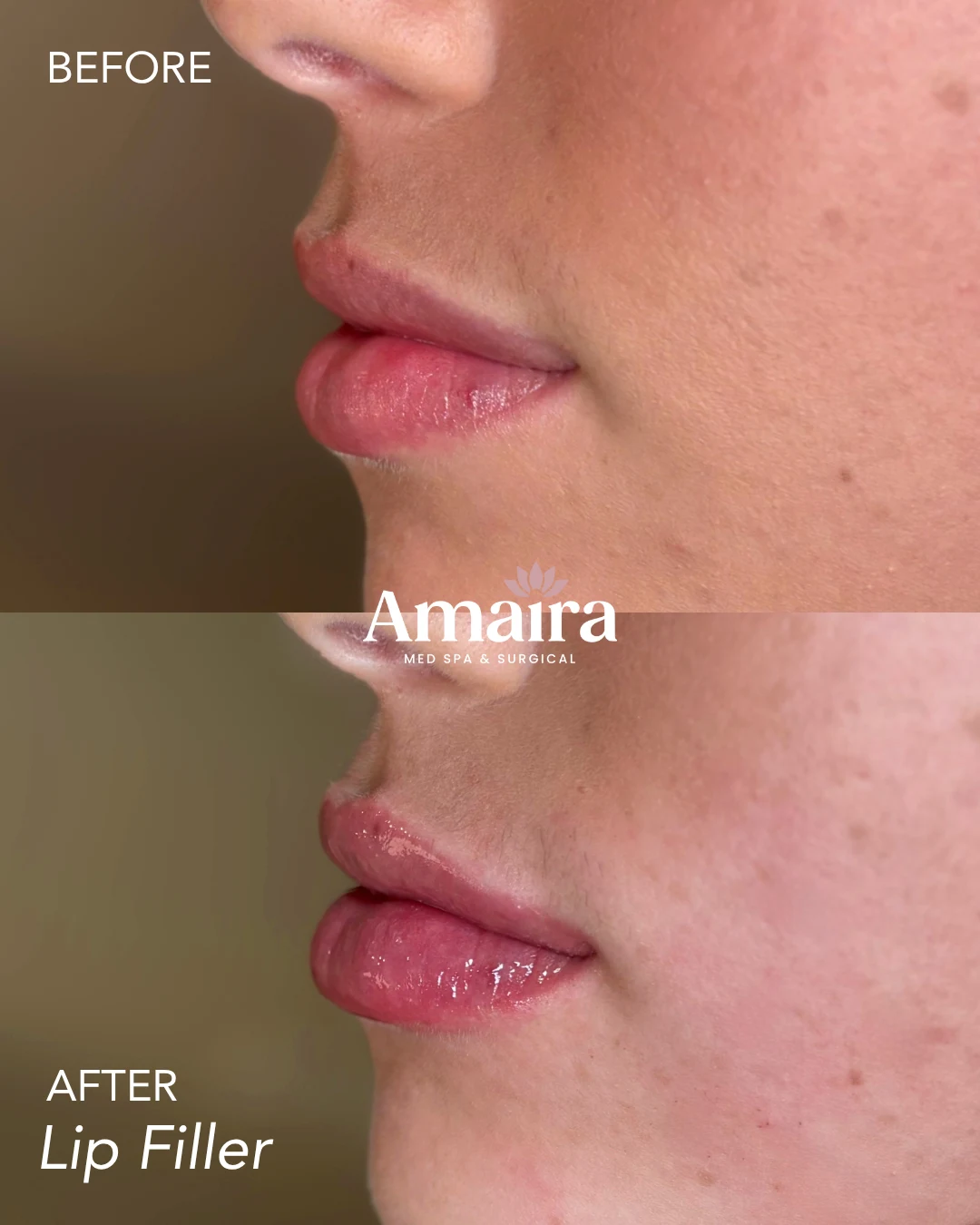 Lip filler before and after, subtle lip volume, side profile close-up, patient 9, enlarged