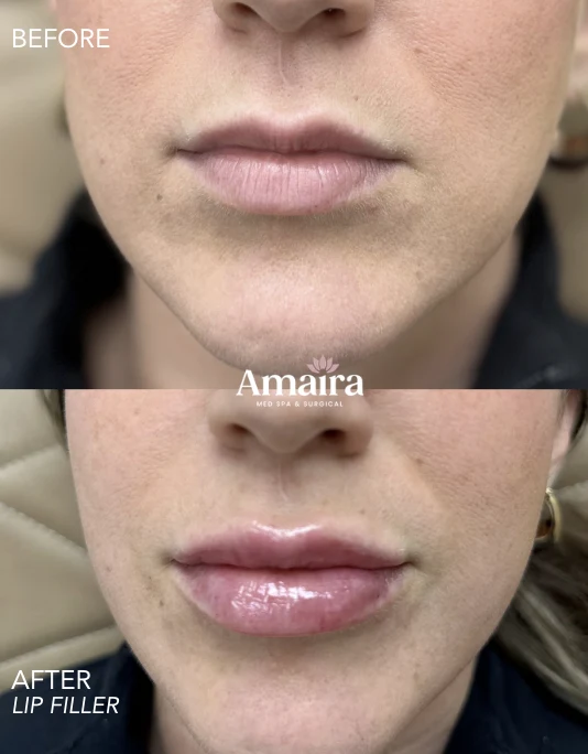 Lip filler before and after, balanced fuller lips, front close-up, patient 10