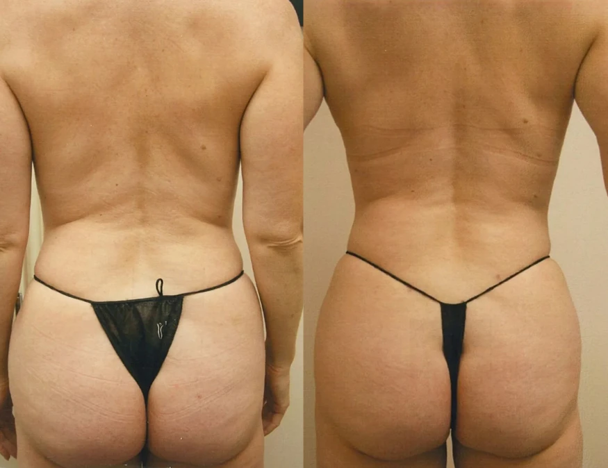 Liposuction before and after results, back view of the waist, flanks and hips