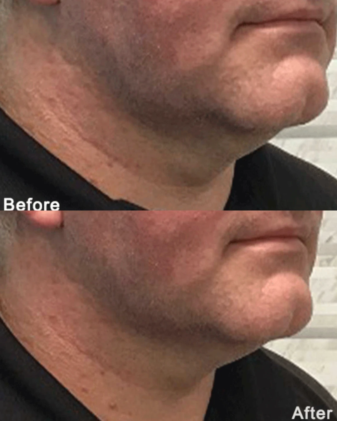 Morpheus8 before and after results, men's jawline, side view, patient 2, enlarged