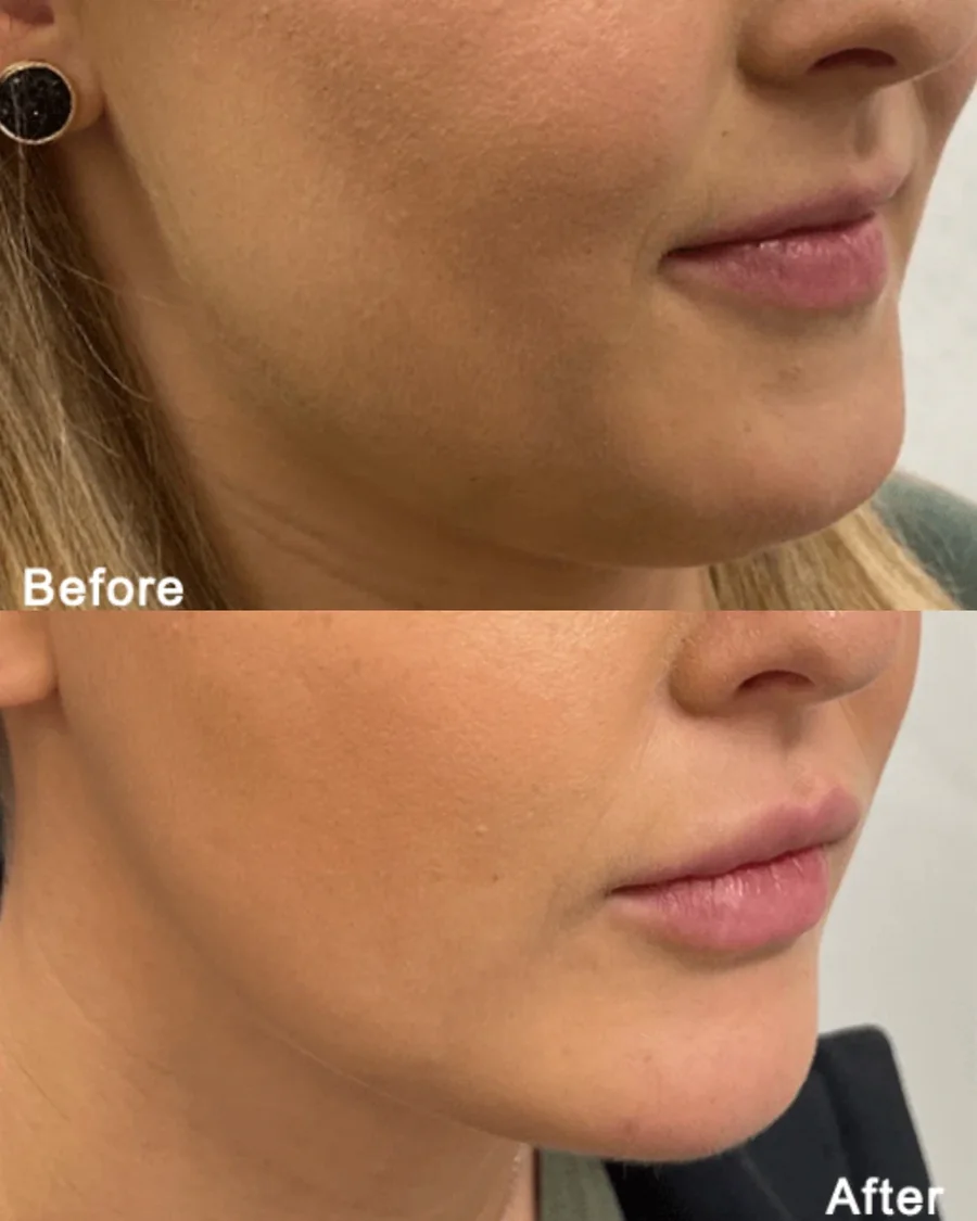 Morpheus8 before and after results, lower face and jawline, side view, patient 1