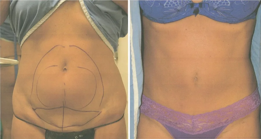 Tummy Tuck before and after