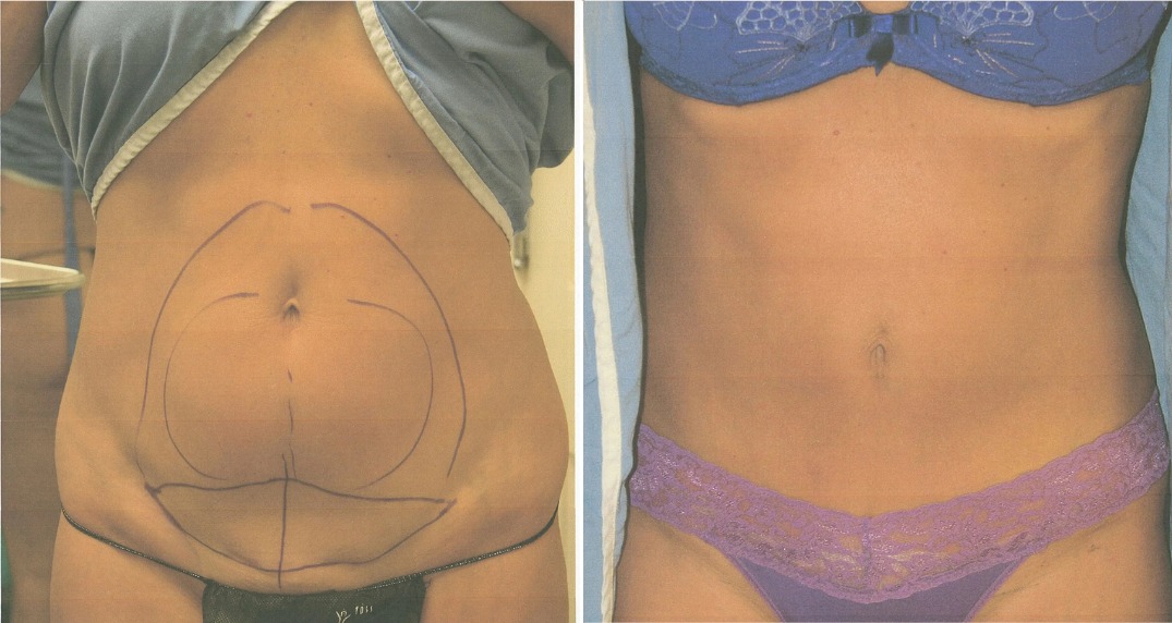 Tummy Tuck before and after