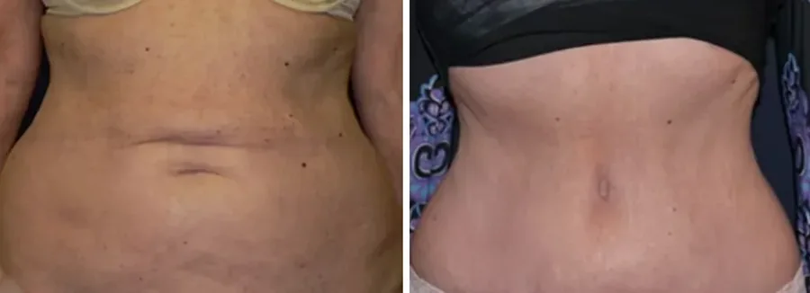 Tummy Tuck before and after