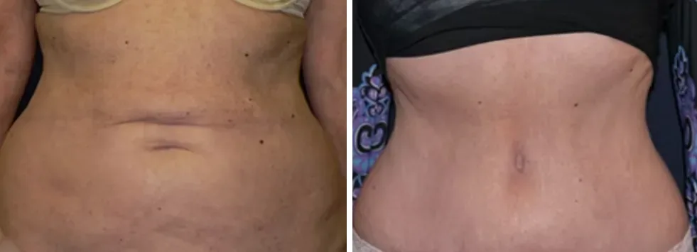 Tummy Tuck before and after