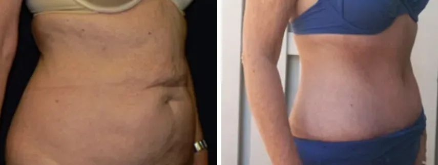 Tummy Tuck before and after