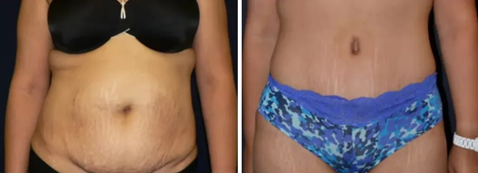 Tummy Tuck before and after