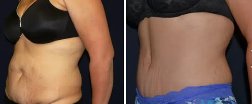 Tummy Tuck before and after
