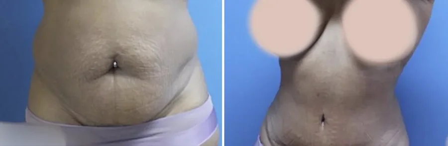 Tummy Tuck before and after