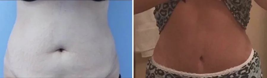 Tummy Tuck before and after
