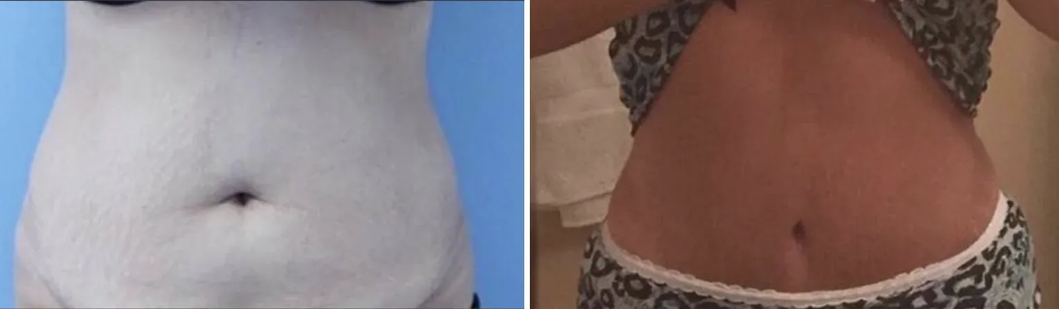 Tummy Tuck before and after