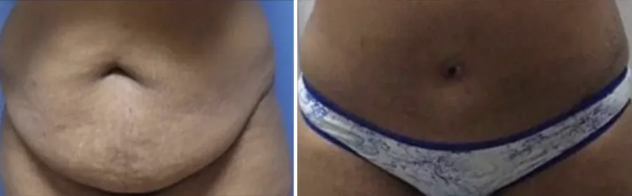 Tummy Tuck before and after