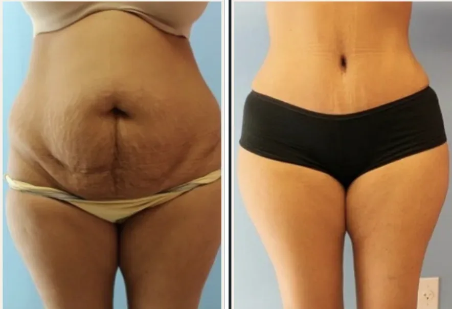 Tummy Tuck before and after