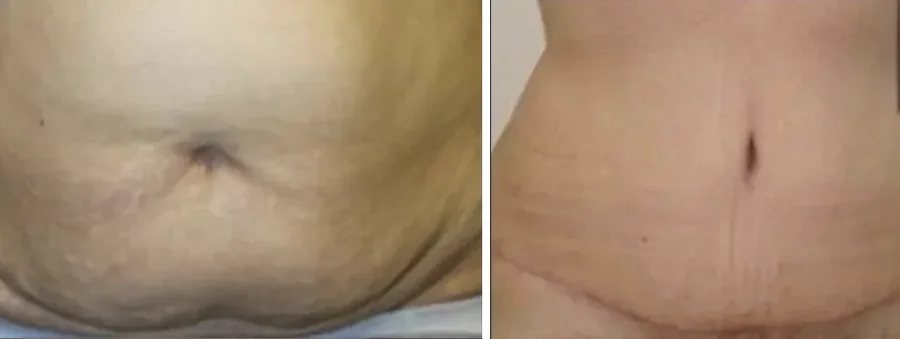 Tummy Tuck before and after