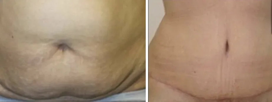 Tummy Tuck before and after