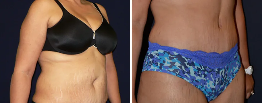 Tummy Tuck before and after