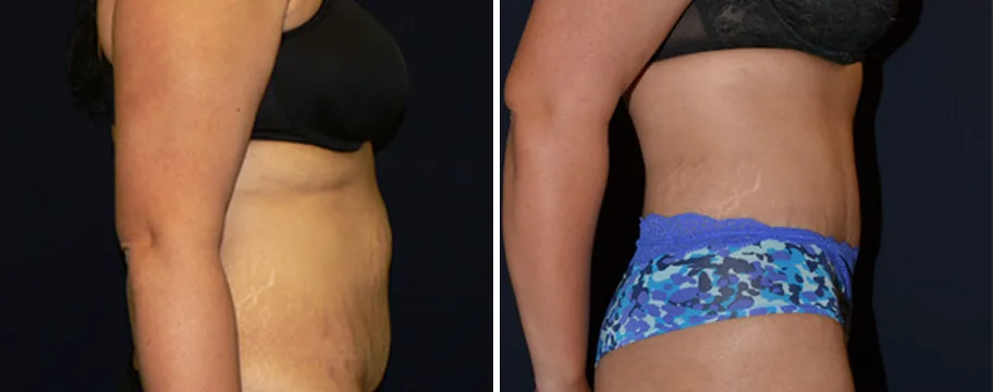 Tummy Tuck before and after