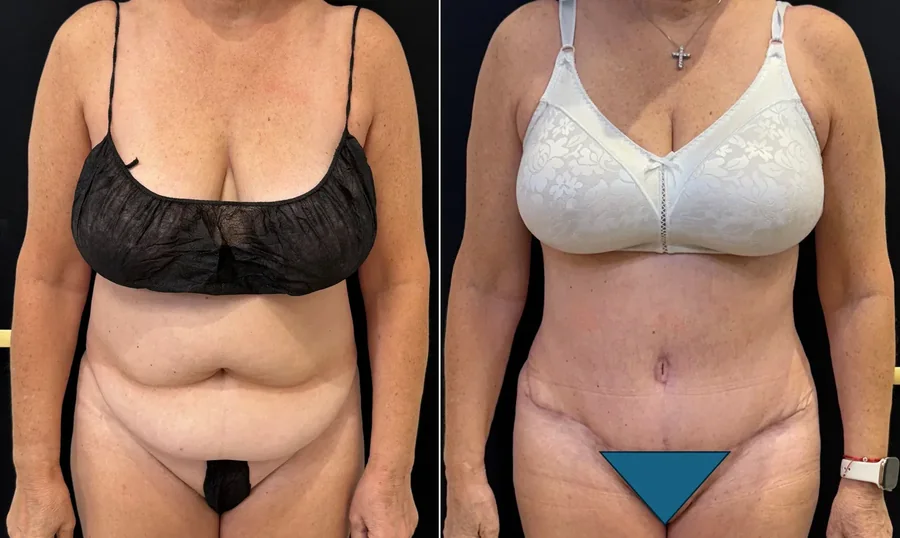 Tummy Tuck before and after