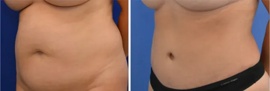 Tummy Tuck before and after