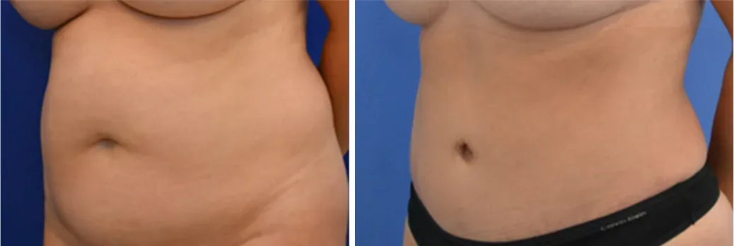 Tummy Tuck before and after