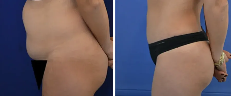 Tummy Tuck before and after