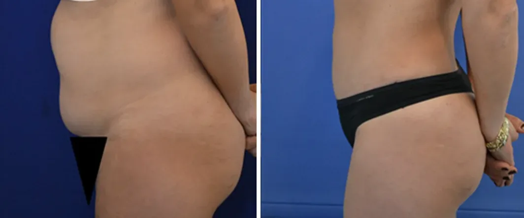 Tummy Tuck before and after