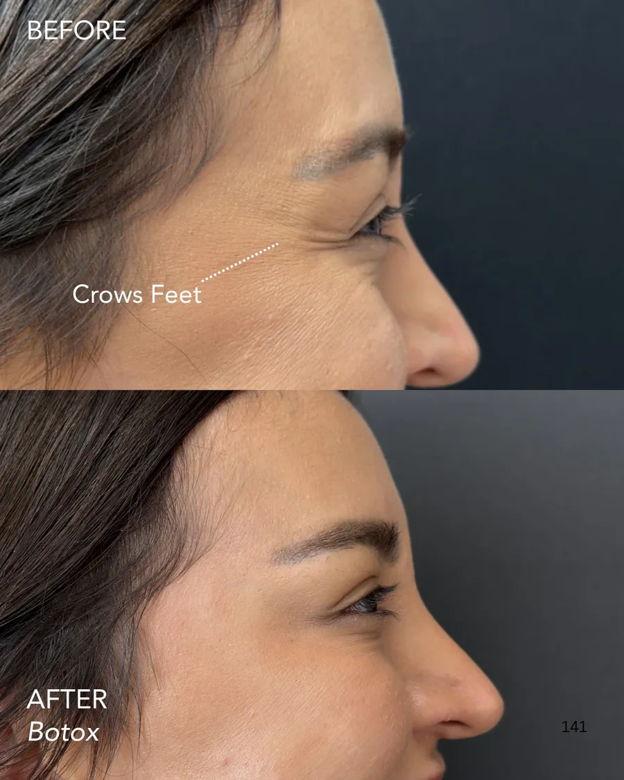 Wrinkle relaxer before and after results, crow's feet, side view, patient 5