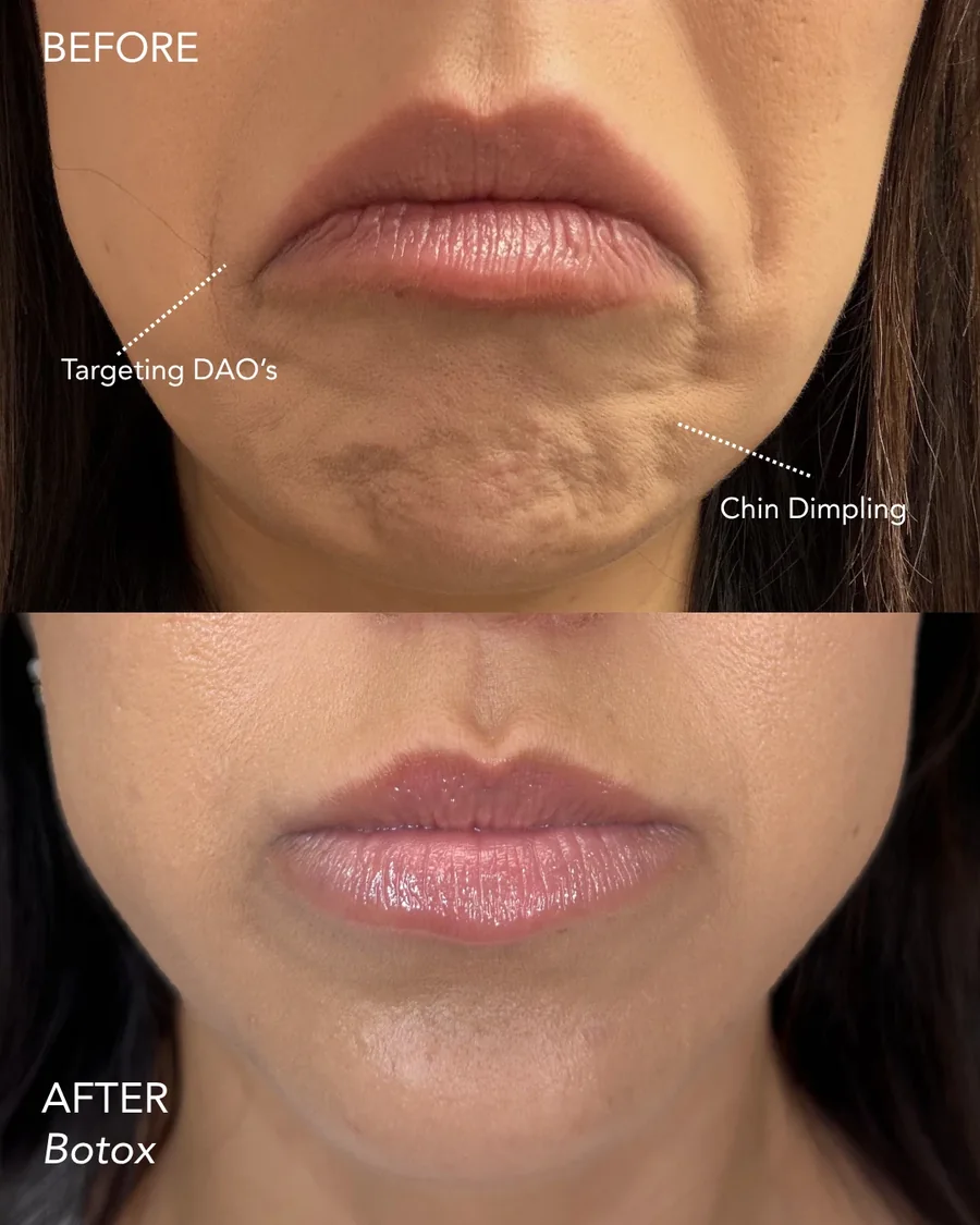 Wrinkle relaxer before and after results, frown lines and chin dimpling, front view, patient 4