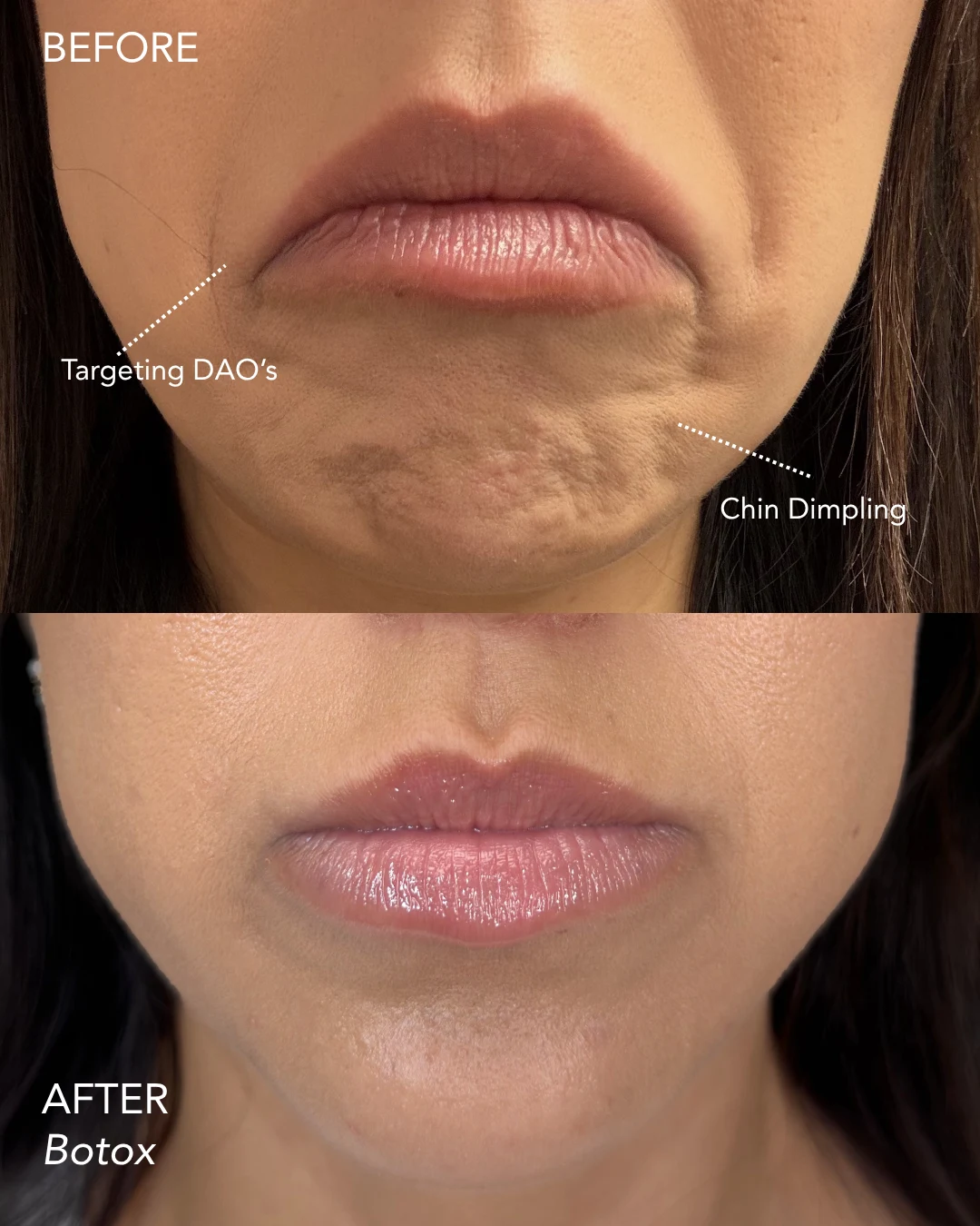 Wrinkle relaxer before and after results, frown lines and chin dimpling, front view, patient 4, enlarged