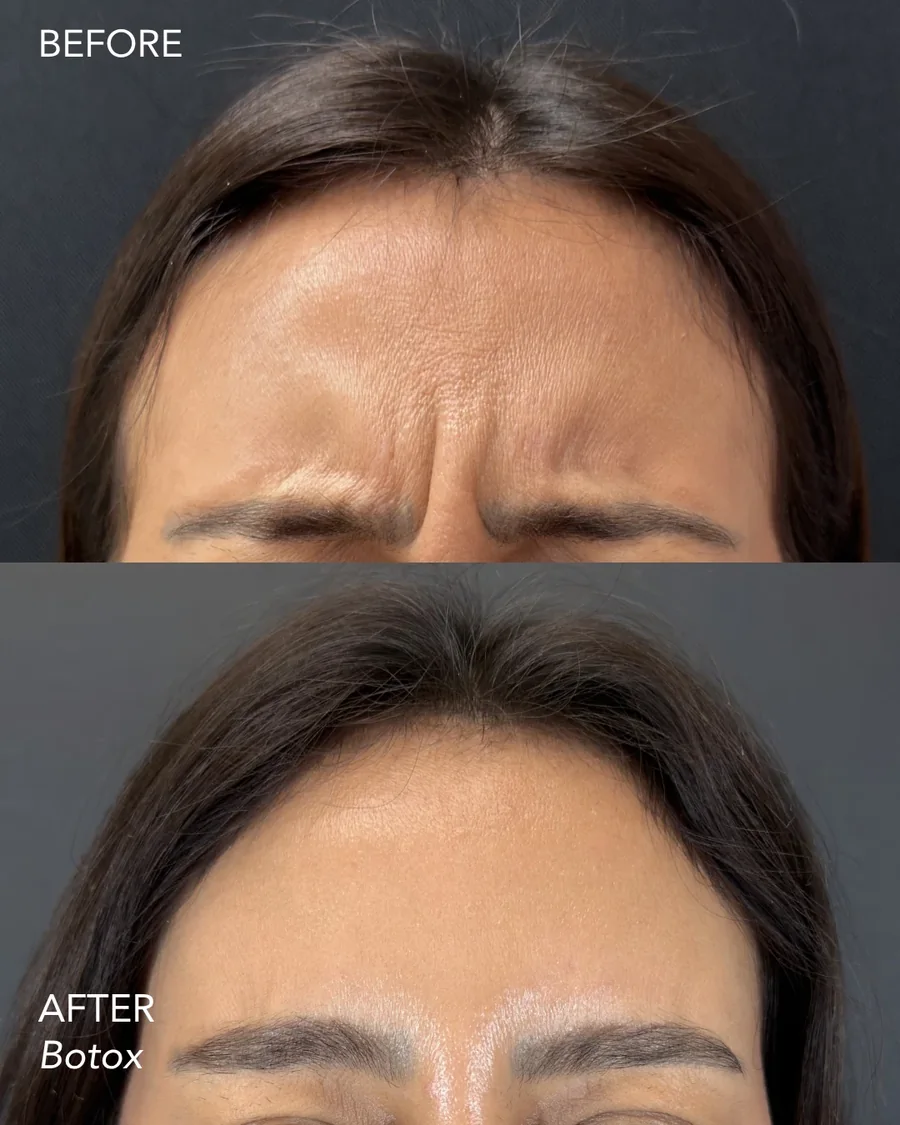 Wrinkle relaxer before and after, frown lines between the brows, front view, patient 1