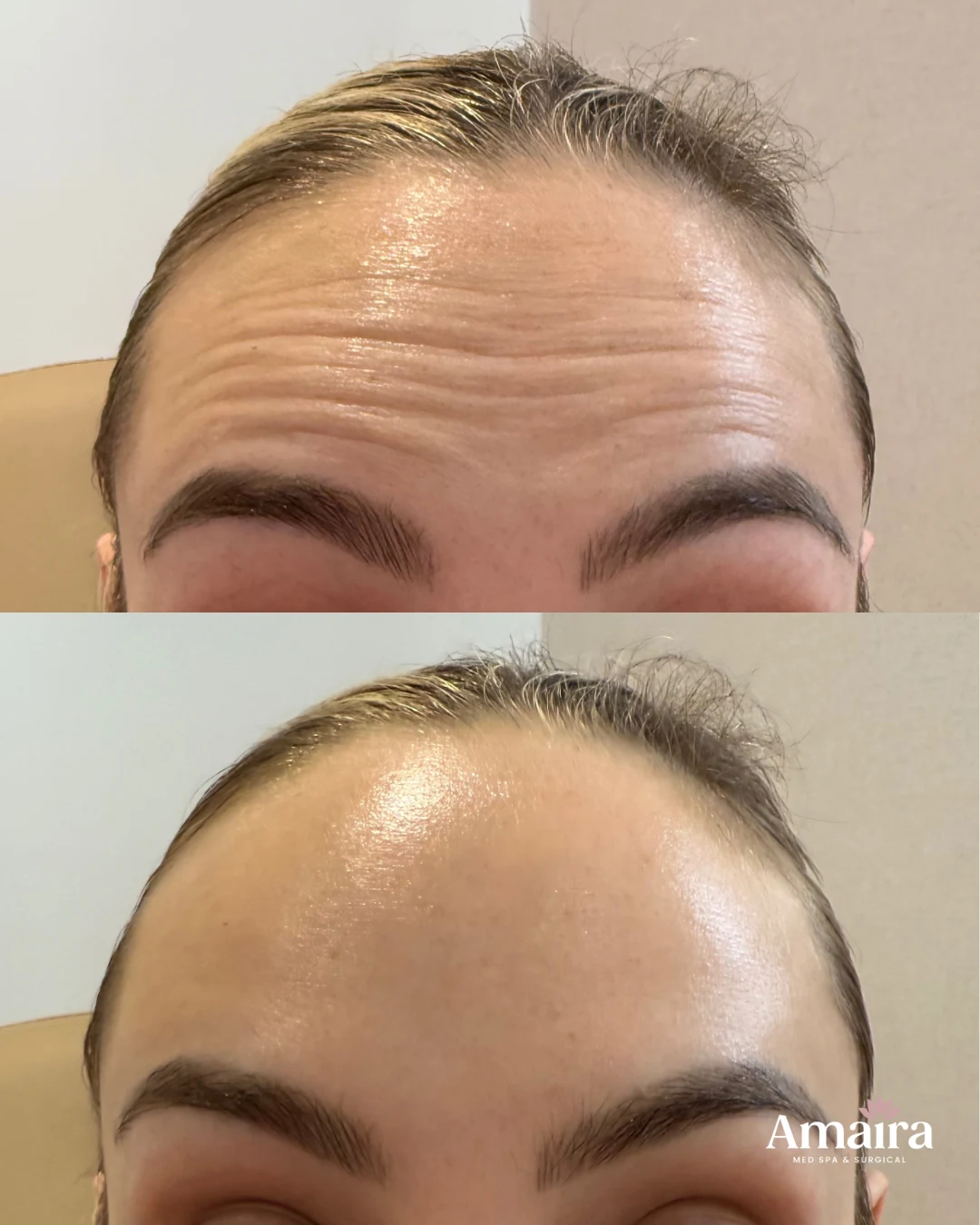 Wrinkle relaxer before and after, forehead lines, front close-up, patient 3, enlarged
